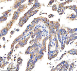 Immunohistochemical staining of DEPDC6/DEPTOR using anti-DEPTOR antibody. DEPDC6/DEPTOR was detected in a paraffin-embedded section of human lung cancer tissue. Heat mediated antigen retrieval was performed in EDTA buffer (pH 8.0, epitope retrieval solution). The tissue section was blocked with 10% goat serum. The tissue section was then incubated with 2 ug/ml rabbit anti-DEPTOR antibody overnight at 4oC. Peroxidase Conjugated Goat Anti-rabbit IgG was used as secondary antibody and incubated for 30 minutes at 37oC. The tissue section was developed using an HRP secondary and DAB substrate.