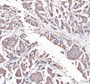 Immunohistochemical staining of APH1A using anti-APH1A antibody. APH1A was detected in a paraffin-embedded section of human breast cancer tissue. Heat mediated antigen retrieval was performed in EDTA buffer (pH 8.0, epitope retrieval solution). The tissue section was blocked with 10% goat serum. The tissue section was then incubated with 2 ug/ml rabbit anti-APH1A antibody overnight at 4oC. Peroxidase Conjugated Goat Anti-rabbit IgG was used as secondary antibody and incubated for 30 minutes at 37oC. The tissue section was developed using an HRP secondary and DAB substrate.