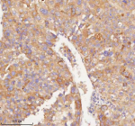 Immunohistochemical staining of RNF25 using anti-RNF25 antibody. RNF25 was detected in a paraffin-embedded section of human liver cancer tissue. Heat mediated antigen retrieval was performed in EDTA buffer (pH 8.0, epitope retrieval solution). The tissue section was blocked with 10% goat serum. The tissue section was then incubated with 2 ug/ml rabbit anti-RNF25 antibody overnight at 4oC. Peroxidase Conjugated Goat Anti-rabbit IgG was used as secondary antibody and incubated for 30 minutes at 37oC. The tissue section was developed using an HRP secondary and DAB substrate.