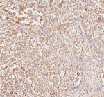 Immunohistochemical staining of RNF25 using anti-RNF25 antibody. RNF25 was detected in a paraffin-embedded section of human lung adenocarcinoma tissue. Heat mediated antigen retrieval was performed in EDTA buffer (pH 8.0, epitope retrieval solution). The tissue section was blocked with 10% goat serum. The tissue section was then incubated with 2 ug/ml rabbit anti-RNF25 antibody overnight at 4oC. Peroxidase Conjugated Goat Anti-rabbit IgG was used as secondary antibody and incubated for 30 minutes at 37oC. The tissue section was developed using an HRP secondary and DAB substrate.