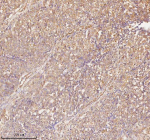 Immunohistochemical staining of RNF25 using anti-RNF25 antibody. RNF25 was detected in a paraffin-embedded section of human ovarian cancer tissue. Heat mediated antigen retrieval was performed in EDTA buffer (pH 8.0, epitope retrieval solution). The tissue section was blocked with 10% goat serum. The tissue section was then incubated with 2 ug/ml rabbit anti-RNF25 antibody overnight at 4oC. Peroxidase Conjugated Goat Anti-rabbit IgG was used as secondary antibody and incubated for 30 minutes at 37oC. The tissue section was developed using an HRP secondary and DAB substrate.