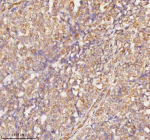 Immunohistochemical staining of RNF25 using anti-RNF25 antibody. RNF25 was detected in a paraffin-embedded section of human ovarian cancer tissue. Heat mediated antigen retrieval was performed in EDTA buffer (pH 8.0, epitope retrieval solution). The tissue section was blocked with 10% goat serum. The tissue section was then incubated with 2 ug/ml rabbit anti-RNF25 antibody overnight at 4oC. Peroxidase Conjugated Goat Anti-rabbit IgG was used as secondary antibody and incubated for 30 minutes at 37oC. The tissue section was developed using an HRP secondary and DAB substrate.