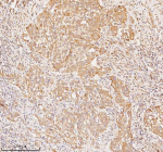 Immunohistochemical staining of RNF25 using anti-RNF25 antibody. RNF25 was detected in a paraffin-embedded section of human urothelial carcinoma tissue. Heat mediated antigen retrieval was performed in EDTA buffer (pH 8.0, epitope retrieval solution). The tissue section was blocked with 10% goat serum. The tissue section was then incubated with 2 ug/ml rabbit anti-RNF25 antibody overnight at 4oC. Peroxidase Conjugated Goat Anti-rabbit IgG was used as secondary antibody and incubated for 30 minutes at 37oC. The tissue section was developed using an HRP secondary and DAB substrate.