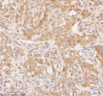 Immunohistochemical staining of RNF25 using anti-RNF25 antibody. RNF25 was detected in a paraffin-embedded section of human urothelial carcinoma tissue. Heat mediated antigen retrieval was performed in EDTA buffer (pH 8.0, epitope retrieval solution). The tissue section was blocked with 10% goat serum. The tissue section was then incubated with 2 ug/ml rabbit anti-RNF25 antibody overnight at 4oC. Peroxidase Conjugated Goat Anti-rabbit IgG was used as secondary antibody and incubated for 30 minutes at 37oC. The tissue section was developed using an HRP secondary and DAB substrate.