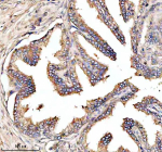 Immunohistochemical staining of NOXO1 using anti-NOXO1 antibody. NOXO1 was detected in a paraffin-embedded section of human prostate cancer tissue. Heat mediated antigen retrieval was performed in EDTA buffer (pH 8.0, epitope retrieval solution). The tissue section was blocked with 10% goat serum. The tissue section was then incubated with 2 ug/ml rabbit anti-NOXO1 antibody overnight at 4oC. Peroxidase Conjugated Goat Anti-rabbit IgG was used as secondary antibody and incubated for 30 minutes at 37oC. The tissue section was developed using an HRP secondary and DAB substrate.