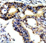Immunohistochemical staining of REST using anti-REST antibody. REST was detected in a paraffin-embedded section of human colon cancer tissue. Heat mediated antigen retrieval was performed in EDTA buffer (pH 8.0, epitope retrieval solution). The tissue section was blocked with 10% goat serum. The tissue section was then incubated with 2 ug/ml rabbit anti-REST antibody overnight at 4oC. Peroxidase Conjugated Goat Anti-rabbit IgG was used as secondary antibody and incubated for 30 minutes at 37oC. The tissue section was developed using an HRP secondary and DAB substrate.