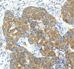 Immunohistochemical staining of PIP5K1A using anti-PIP5K1A antibody. PIP5K1A was detected in a paraffin-embedded section of human liver cancer tissue. Heat mediated antigen retrieval was performed in EDTA buffer (pH 8.0, epitope retrieval solution). The tissue section was blocked with 10% goat serum. The tissue section was then incubated with 2 ug/ml rabbit anti-PIP5K1A antibody overnight at 4oC. Peroxidase Conjugated Goat Anti-rabbit IgG was used as secondary antibody and incubated for 30 minutes at 37oC. The tissue section was developed using an HRP secondary and DAB substrate.