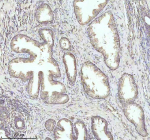 Immunohistochemical staining of PIPOX using anti-PIPOX antibody. PIPOX was detected in a paraffin-embedded section of human prostate cancer tissue. Heat mediated antigen retrieval was performed in EDTA buffer (pH 8.0, epitope retrieval solution). The tissue section was blocked with 10% goat serum. The tissue section was then incubated with 2 ug/ml rabbit anti-PIPOX antibody overnight at 4oC. Peroxidase Conjugated Goat Anti-rabbit IgG was used as secondary antibody and incubated for 30 minutes at 37oC. The tissue section was developed using an HRP secondary and DAB substrate.