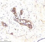 Immunohistochemical staining of ATP1A2 using anti-ATP1A2 antibody. ATP1A2 was detected in a paraffin-embedded section of human breast cancer tissue. Heat mediated antigen retrieval was performed in EDTA buffer (pH 8.0, epitope retrieval solution). The tissue section was blocked with 10% goat serum. The tissue section was then incubated with 2 ug/ml rabbit anti-ATP1A2 antibody overnight at 4oC. Peroxidase Conjugated Goat Anti-rabbit IgG was used as secondary antibody and incubated for 30 minutes at 37oC. The tissue section was developed using an HRP secondary and DAB substrate.