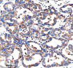 Immunohistochemical staining of GEF-H1/ARHGEF2 using anti-ARHGEF2 antibody. GEF-H1/ARHGEF2 was detected in a paraffin-embedded section of human ovarian cancer tissue. Heat mediated antigen retrieval was performed in EDTA buffer (pH 8.0, epitope retrieval solution). The tissue section was blocked with 10% goat serum. The tissue section was then incubated with 2 ug/ml rabbit anti-ARHGEF2 antibody overnight at 4oC. Peroxidase Conjugated Goat Anti-rabbit IgG was used as secondary antibody and incubated for 30 minutes at 37oC. The tissue section was developed using an HRP secondary and DAB substrate.