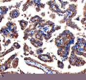 Immunohistochemical staining of GEF-H1/ARHGEF2 using anti-ARHGEF2 antibody. GEF-H1/ARHGEF2 was detected in a paraffin-embedded section of human ovary cancer tissue. Heat mediated antigen retrieval was performed in EDTA buffer (pH 8.0, epitope retrieval solution). The tissue section was blocked with 10% goat serum. The tissue section was then incubated with 2 ug/ml rabbit anti-ARHGEF2 antibody overnight at 4oC. Peroxidase Conjugated Goat Anti-rabbit IgG was used as secondary antibody and incubated for 30 minutes at 37oC. The tissue section was developed using an HRP secondary and DAB substrate.