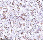 Immunohistochemical staining of SSH3 using anti-SSH3 antibody. SSH3 was detected in a paraffin-embedded section of human breast cancer tissue. Heat mediated antigen retrieval was performed in EDTA buffer (pH 8.0, epitope retrieval solution). The tissue section was blocked with 10% goat serum. The tissue section was then incubated with 2 ug/ml rabbit anti-SSH3 antibody overnight at 4oC. Peroxidase Conjugated Goat Anti-rabbit IgG was used as secondary antibody and incubated for 30 minutes at 37oC. The tissue section was developed using an HRP secondary and DAB substrate.
