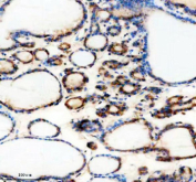 Immunohistochemical staining of THRAP3 using anti-THRAP3 antibody. THRAP3 was detected in a paraffin-embedded section of human thyroid cancer tissue. Heat mediated antigen retrieval was performed in EDTA buffer (pH 8.0, epitope retrieval solution). The tissue section was blocked with 10% goat serum. The tissue section was then incubated with 2 ug/ml rabbit anti-THRAP3 antibody overnight at 4oC. Peroxidase Conjugated Goat Anti-rabbit IgG was used as secondary antibody and incubated for 30 minutes at 37oC. The tissue section was developed using an HRP secondary and DAB substrate.