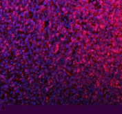 Immunofluorescent staining of SILV/PMEL using anti-PMEL antibody (red). SILV/PMEL was detected in a paraffin-embedded section of human melanoma tissue. Heat mediated antigen retrieval was performed in EDTA buffer (pH 8.0, epitope retrieval solution). The tissue section was blocked with 10% goat serum. The tissue section was then incubated with 5 ug/ml rabbit anti-PMEL antibody overnight at 4oC. DyLight 594 Conjugated Goat Anti-Rabbit IgG was used as secondary antibody at 1:500 dilution and incubated for 30 minutes at 37oC. The section was counterstained with DAPI nuclear stain (blue). Visualize using a fluorescence microscope and filter sets appropriate for the label used.