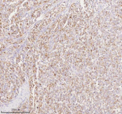 Immunohistochemical staining of SILV/PMEL using anti-PMEL antibody. SILV/PMEL was detected in a paraffin-embedded section of human melanoma tissue. Heat mediated antigen retrieval was performed in EDTA buffer (pH 8.0, epitope retrieval solution). The tissue section was blocked with 10% goat serum. The tissue section was then incubated with 2 ug/ml rabbit anti-PMEL antibody overnight at 4oC. Peroxidase Conjugated Goat Anti-rabbit IgG was used as secondary antibody and incubated for 30 minutes at 37oC. The tissue section was developed using an HRP secondary and DAB substrate.