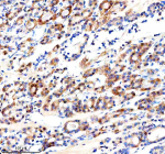 Immunohistochemical staining of Cathepsin F/CTSF using anti-CTSF antibody. Cathepsin F/CTSF was detected in a paraffin-embedded section of human thyroid cancer tissue. Heat mediated antigen retrieval was performed in EDTA buffer (pH 8.0, epitope retrieval solution). The tissue section was blocked with 10% goat serum. The tissue section was then incubated with 2 ug/ml rabbit anti-CTSF antibody overnight at 4oC. Peroxidase Conjugated Goat Anti-rabbit IgG was used as secondary antibody and incubated for 30 minutes at 37oC. The tissue section was developed using an HRP secondary and DAB substrate.