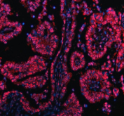 Immunofluorescent staining of PRDM11 using anti-PRDM11 antibody (red). PRDM11 was detected in a paraffin-embedded section of human lung cancer tissue. Heat mediated antigen retrieval was performed in EDTA buffer (pH 8.0, epitope retrieval solution). The tissue section was blocked with 10% goat serum. The tissue section was then incubated with 5 ug/ml rabbit anti-PRDM11 antibody overnight at 4oC. Cy3 Conjugated Goat Anti-Rabbit IgG was used as secondary antibody at 1:500 dilution and incubated for 30 minutes at 37oC. The section was counterstained with DAPI nuclear stain (blue). Visualize using a fluorescence microscope and filter sets appropriate for the label used.
