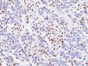 IHC staining of FFPE human seminoma tissue with recombinant H3K27me3 antibody. HIER: boil tissue sections in pH6, 10mM citrate buffer, for 20 min and allow to cool before testing.