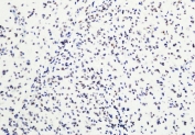 IHC staining of FFPE human glioblastoma tissue with recombinant H3K27me3 antibody. HIER: boil tissue sections in pH6, 10mM citrate buffer, for 20 min and allow to cool before testing.