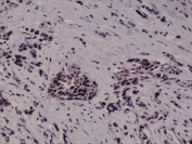 IHC testing of FFPE human breast cancer tissue with recombinant HIF1A antibody at 1:1000.