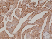 IHC staining of FFPE human prostate cancer tissue with recombinant Prostate Specific Antigen antibody at 1:1000.