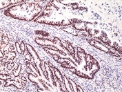 IHC staining of FFPE human colon cancer tissue with recombinant MSH3 antibody at 1:200.