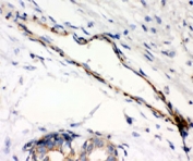IHC testing of FFPE human breast cancer with Caldesmon antibody (clone CD-7). HIER: steamed with pH6 citrate buffer.