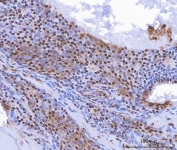 IHC staining of FFPE human thyroid cancer tissue with c-Myc antibody. HIER: boil tissue sections in pH8 EDTA for 20 min and allow to cool before testing.