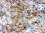 IHC testing of FFPE human meningeoma tissue with Synaptophysin antibody. HIER: Boil the paraffin sections in pH 6, 10mM citrate buffer for 20 minutes and allow to cool prior to testing.