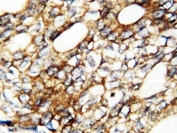 IHC-P: FGF1 antibody testing of human breast cancer tissue