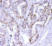 IHC staining of FFPE human colon cancer tissue with Survivin antibody. HIER: boil tissue sections in pH8 EDTA for 20 min and allow to cool before testing.