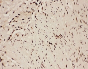 IHC-P: 5-Lipoxygenase antibody testing of human intestine cancer tissue