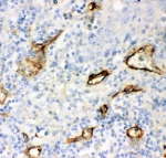 IHC-P: CD146 antibody testing of human lung cancer tissue