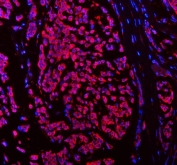Immunofluorescent staining of FFPE human breast cancer tissue with SSH3BP1 antibody (red) and DAPI nuclear stain (blue). HIER: steam section in pH8 EDTA buffer for 20 min.