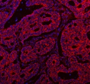 Immunofluorescent staining of FFPE human intestinal cancer tissue with SSH3BP1 antibody (red) and DAPI nuclear stain (blue). HIER: steam section in pH8 EDTA buffer for 20 min.