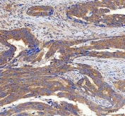 IHC staining of FFPE human colorectal adenocarcinoma tissue with SSH3BP1 antibody. HIER: boil tissue sections in pH8 EDTA for 20 min and allow to cool before testing.