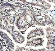 IHC staining of FFPE human colon cancer tissue with Lamin B1 antibody. HIER: boil tissue sections in pH8 EDTA for 20 min and allow to cool before testing.