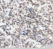 IHC staining of FFPE human breast cancer tissue with Lamin B1 antibody. HIER: boil tissue sections in pH8 EDTA for 20 min and allow to cool before testing.