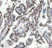 IHC staining of FFPE human lung cancer tissue with Lamin B1 antibody. HIER: boil tissue sections in pH8 EDTA for 20 min and allow to cool before testing.