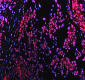 Immunofluorescent staining of FFPE human lung cancer tissue with Lamin B1 antibody (red) and DAPI nuclear stain (blue). HIER: steam section in pH8 EDTA buffer for 20 min.