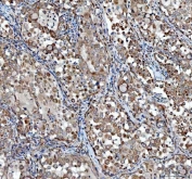 IHC staining of FFPE human lung cancer tissue with TCP1 alpha antibody. HIER: boil tissue sections in pH8 EDTA for 20 min and allow to cool before testing.