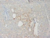 IHC-P: CD18 antibody testing of human uroepithelium cancer tissue