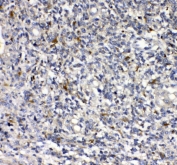 IHC staining of FFPE human glioma tissue with uPAR antibody. HIER: boil tissue sections in pH8 EDTA for 20 min and allow to cool before testing.