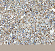 IHC staining of FFPE human liver cancer tissue with Annexin A2 antibody, HRP-secondary and DAB substrate. HIER: boil tissue sections in pH8 EDTA for 20 min and allow to cool before testing.