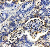 IHC staining of FFPE human stomach cancer tissue with IL-8 antibody. HIER: boil tissue sections in pH8 EDTA for 20 min and allow to cool before testing.