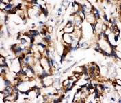 IHC-P: MEK1 antibody testing of human breast cancer tissue