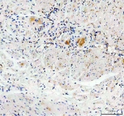 IHC staining of FFPE human stomach cancer tissue with GDNF antibody. HIER: boil tissue sections in pH8 EDTA for 20 min and allow to cool before testing.