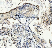 IHC staining of FFPE human lung cancer tissue with GDNF antibody. HIER: boil tissue sections in pH8 EDTA for 20 min and allow to cool before testing.