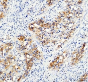 IHC staining of FFPE human bladder cancer tissue with AQP3 antibody. HIER: boil tissue sections in pH8 EDTA for 20 min and allow to cool before testing.
