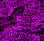 Immunofluorescent staining of FFPE human lung cancer tissue with APEX1 antibody (red). HIER: steam section in pH8 EDTA buffer for 20 min.